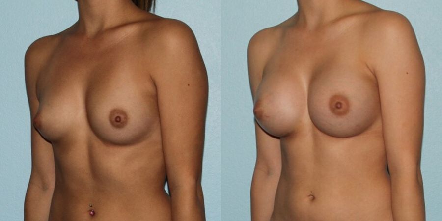 Breast Augmentation - Thumbnail 2