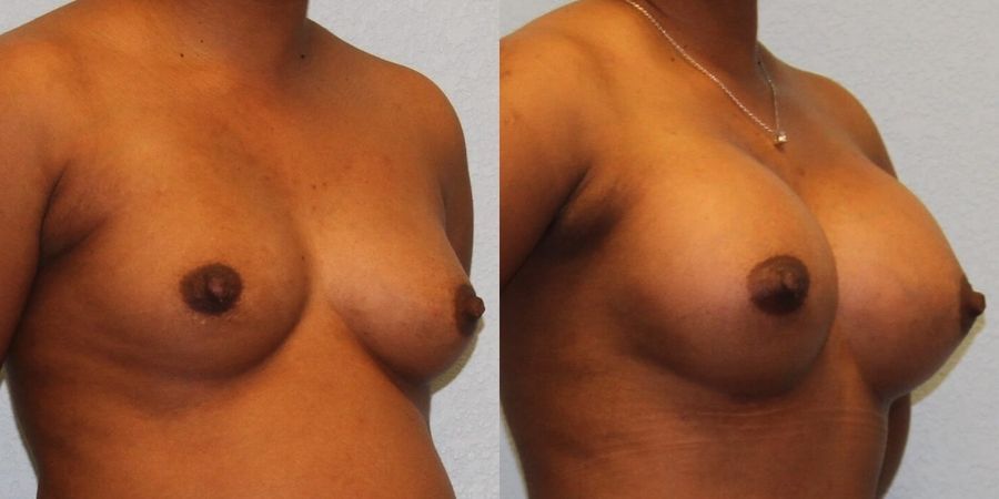 Breast Augmentation - Thumbnail 2