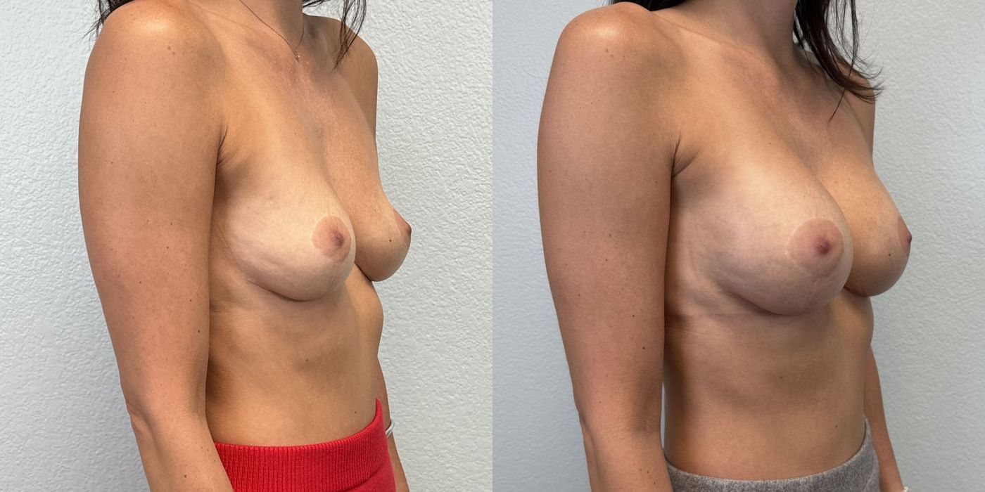 Breast Augmentation - Thumbnail 2