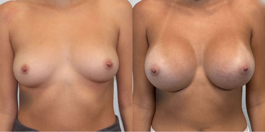 Breast Augmentation - Case 19348