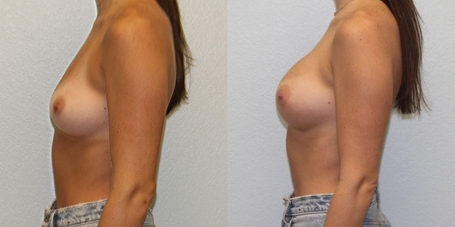 Breast Augmentation - Thumbnail 3