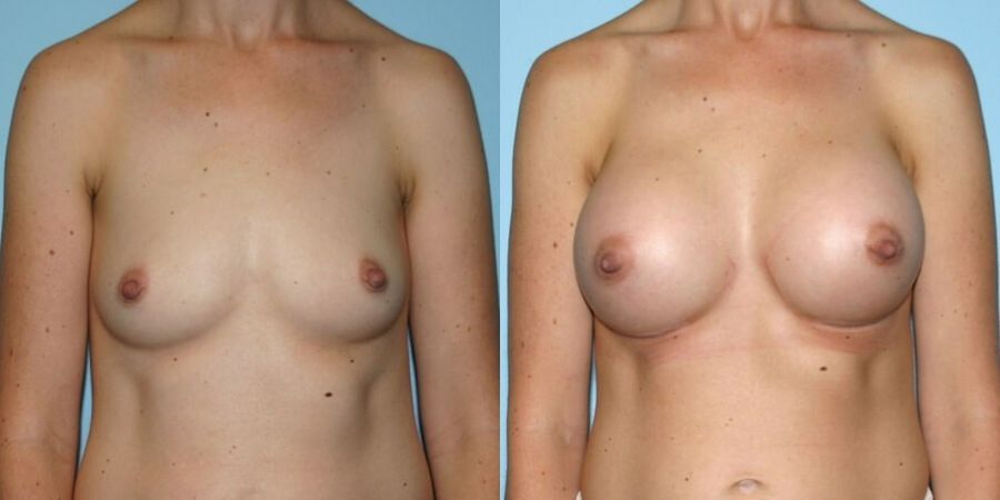 Breast Augmentation - Case 19296