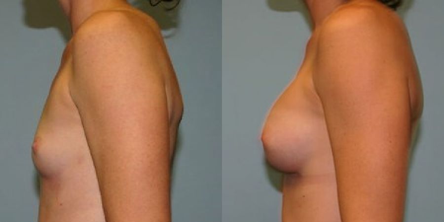 Breast Augmentation - Thumbnail 3