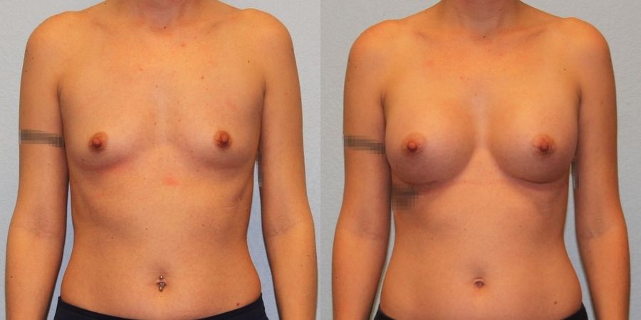 Breast Augmentation - Case 19310