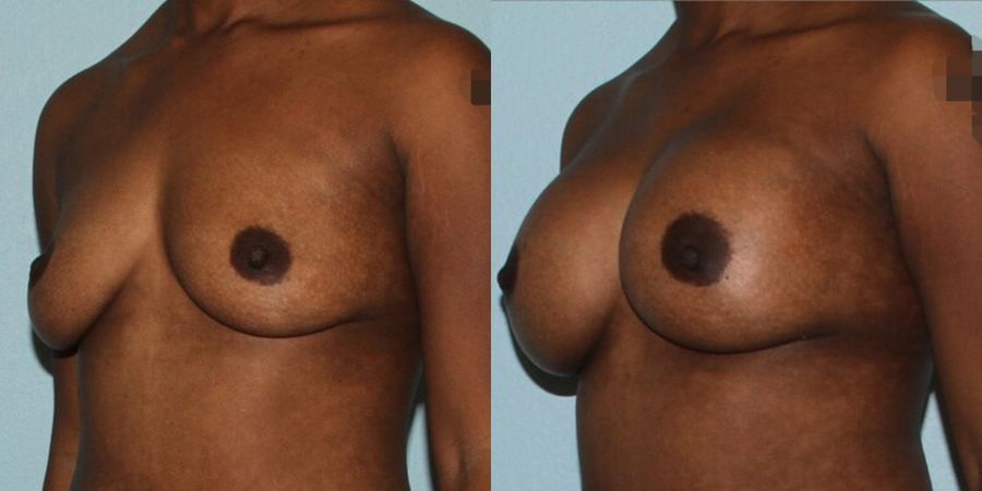 Breast Augmentation - Thumbnail 2