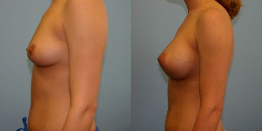 Breast Augmentation - Thumbnail 3