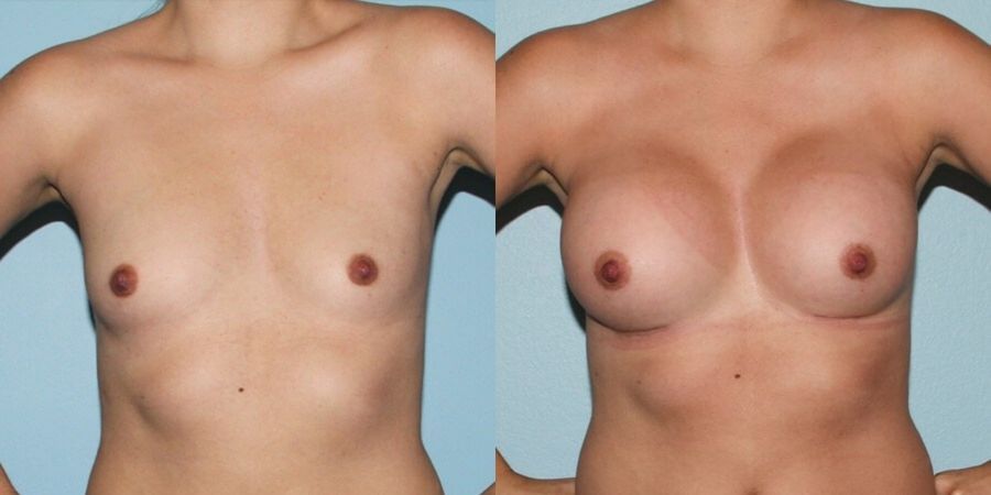 Breast Augmentation - Case 19299