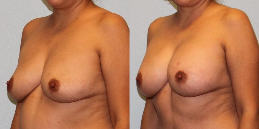 Breast Augmentation - Thumbnail 2
