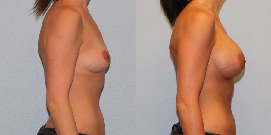 Breast Augmentation - Thumbnail 3