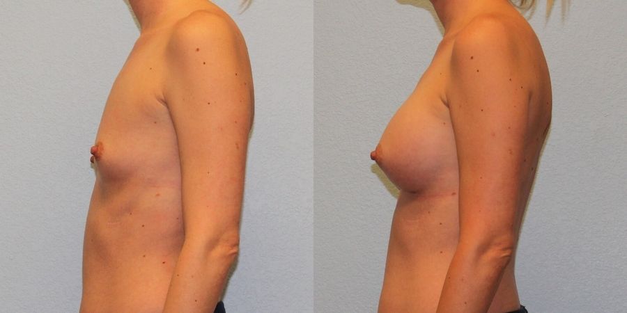 Breast Augmentation - Thumbnail 3