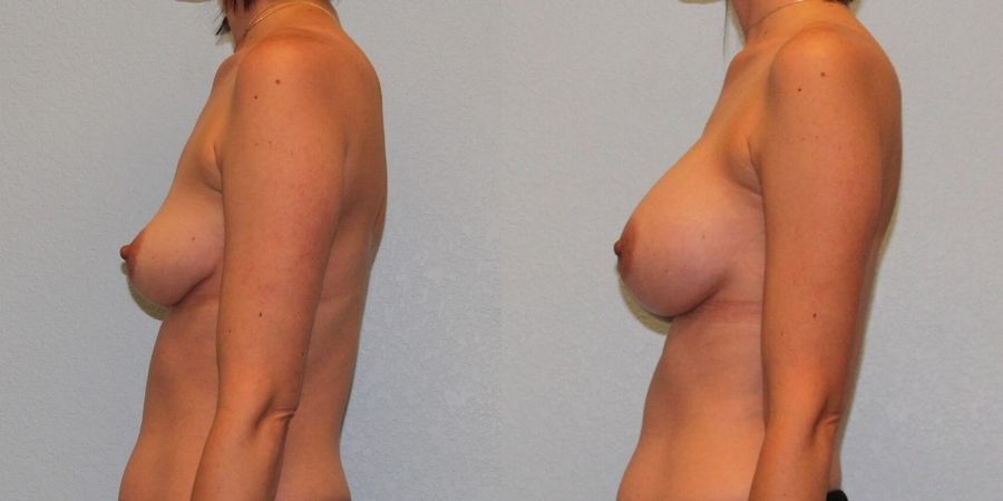 Breast Augmentation - Thumbnail 3