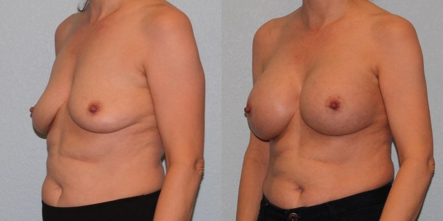 Breast Augmentation - Thumbnail 2