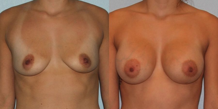 Breast Augmentation - Case 19283