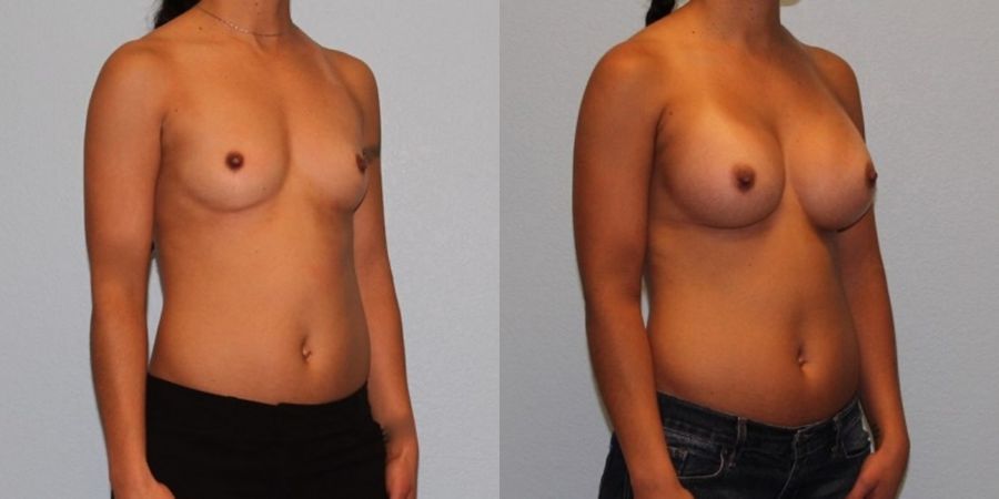 Breast Augmentation - Thumbnail 2