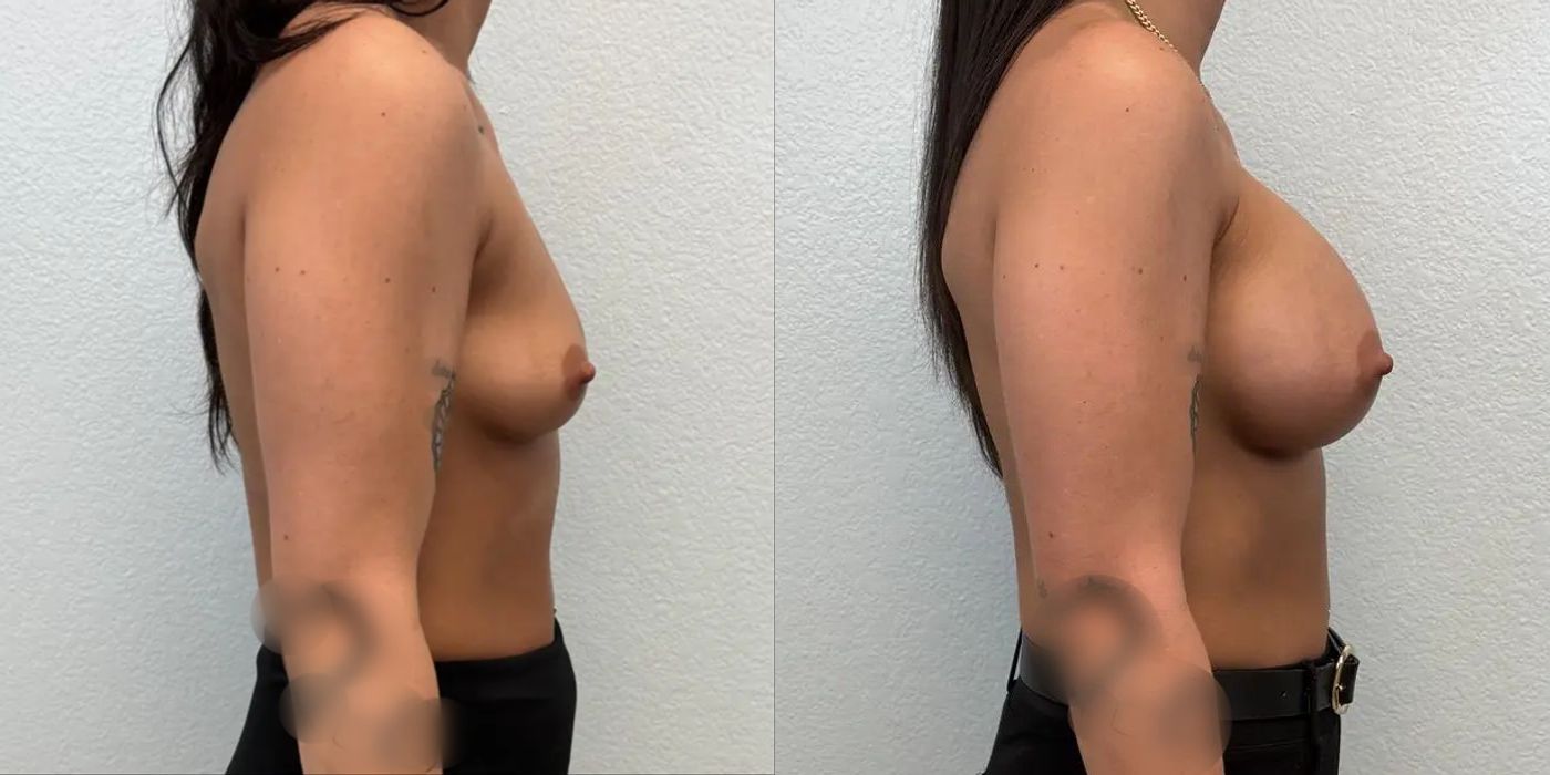 Breast Augmentation - Thumbnail 3