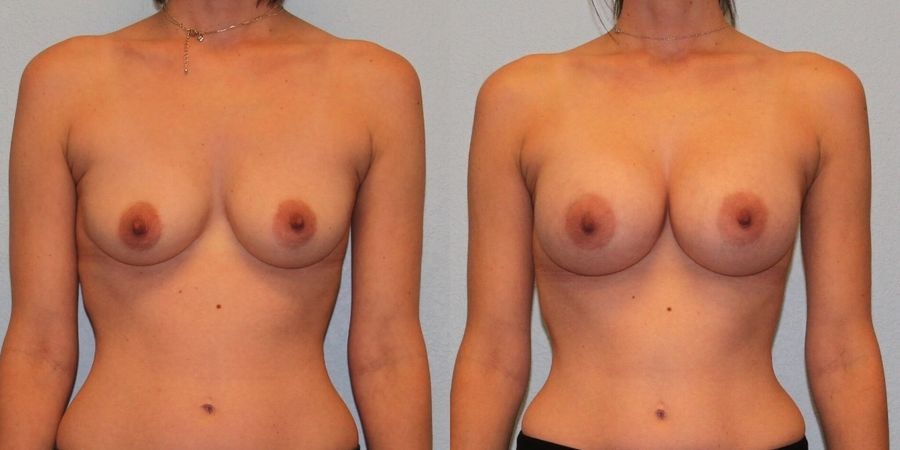 Breast Augmentation - Case 19308