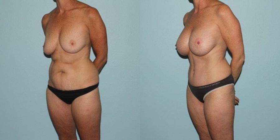 Breast Augmentation - Thumbnail 2