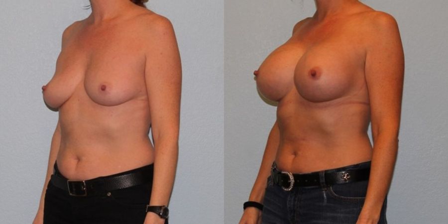 Breast Augmentation - Thumbnail 2