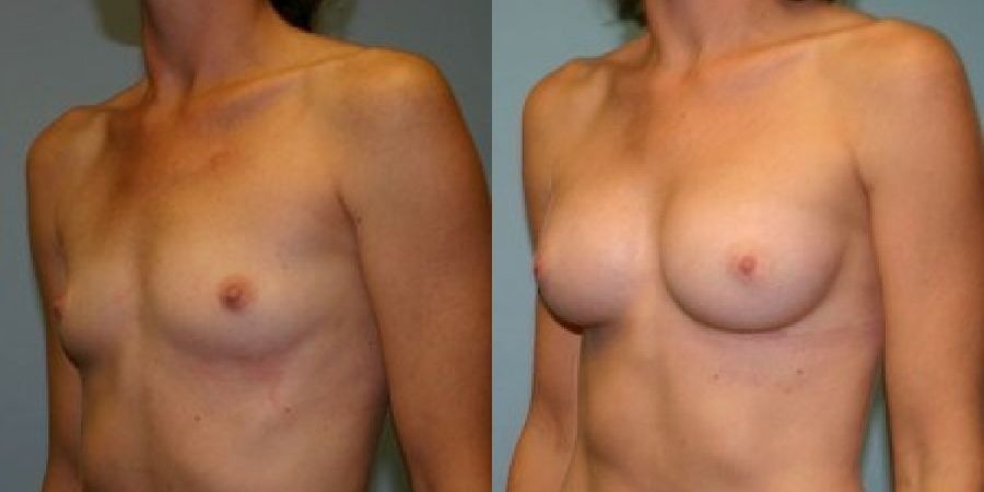Breast Augmentation - Thumbnail 2