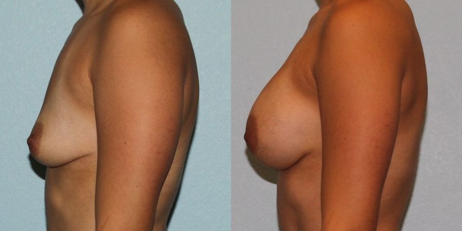 Breast Augmentation - Thumbnail 3