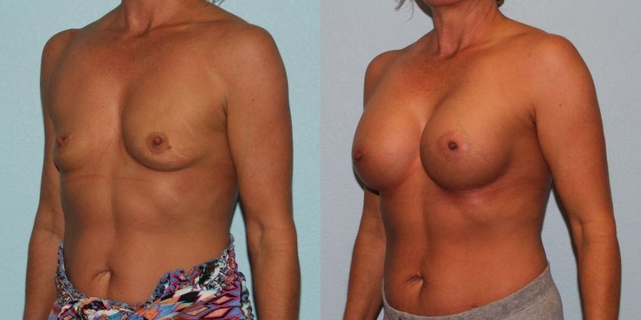 Breast Augmentation - Thumbnail 2