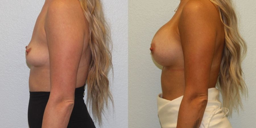Breast Augmentation - Thumbnail 3