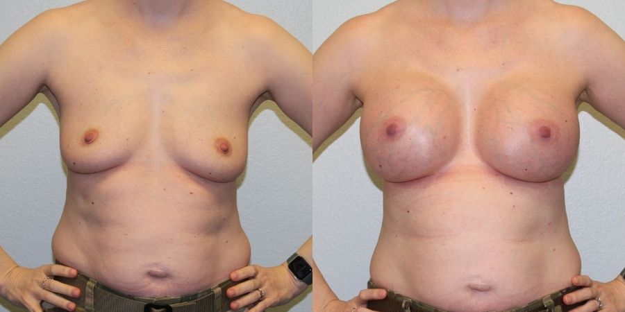 Breast Augmentation - Case 19323