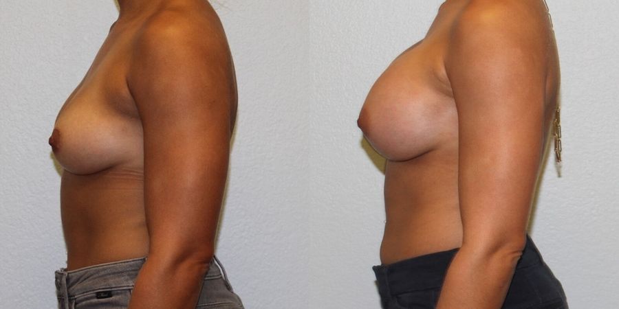 Breast Augmentation - Thumbnail 3