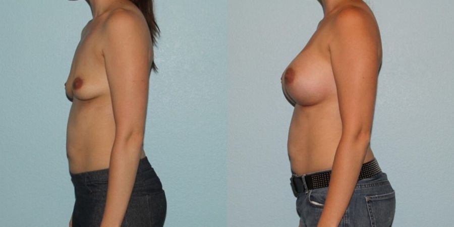 Breast Augmentation - Thumbnail 3