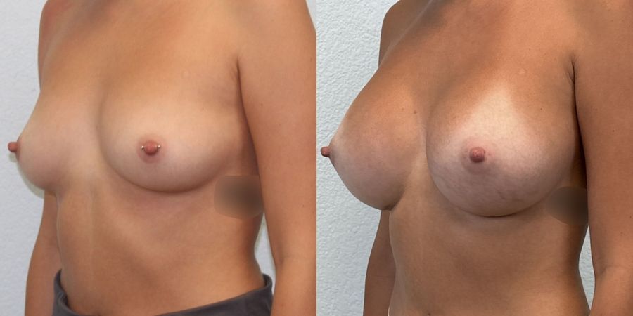 Breast Augmentation - Thumbnail 2