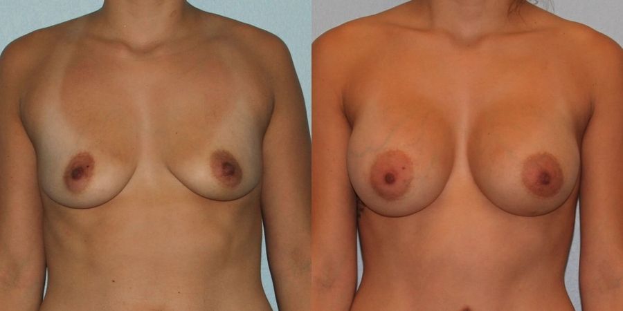 Breast Augmentation - Case 19284