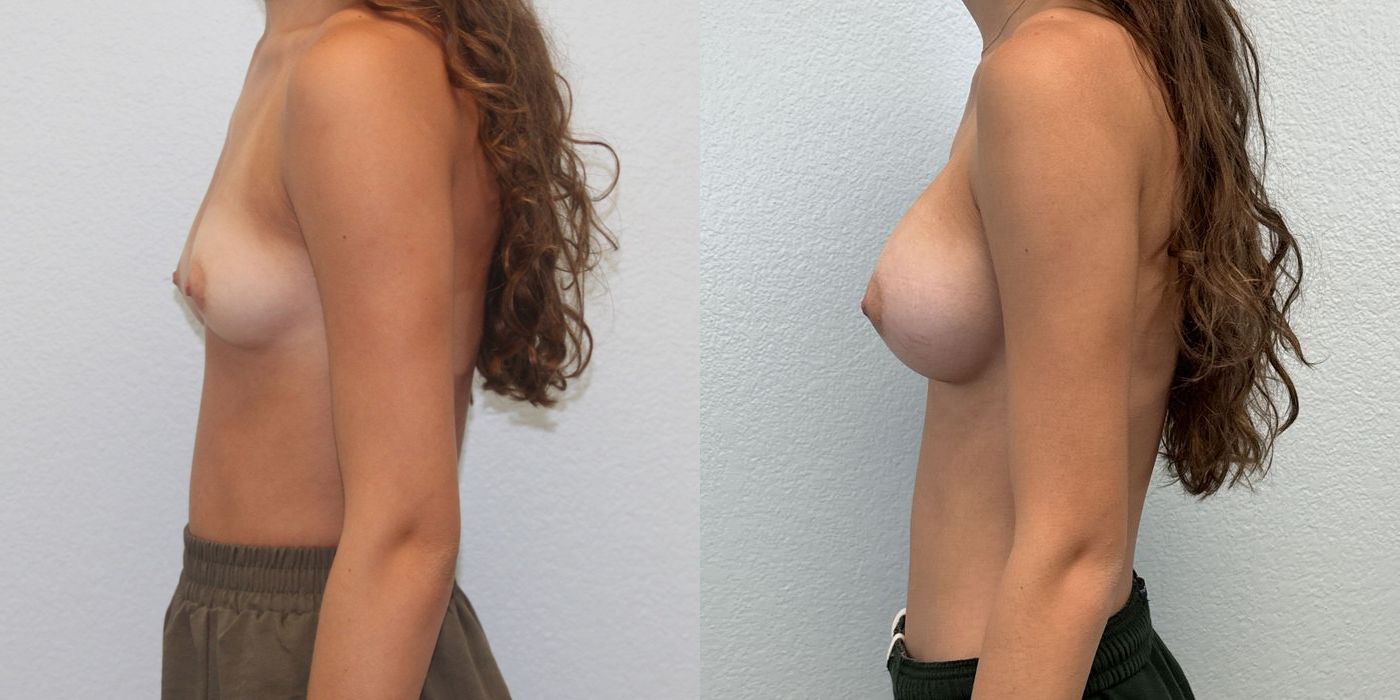 Breast Augmentation - Thumbnail 3