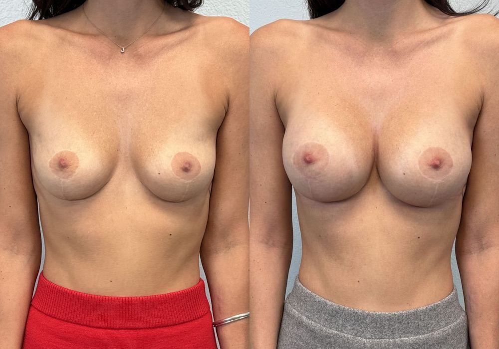 Breast Augmentation - Case 19258