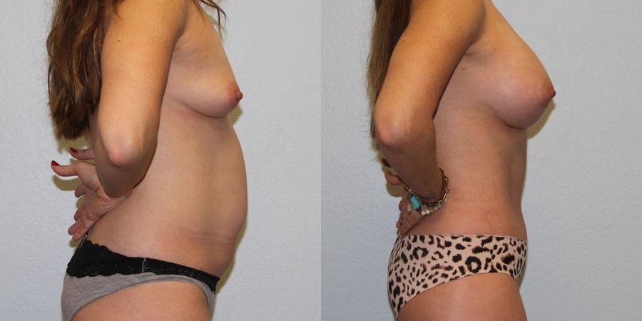 Breast Augmentation - Thumbnail 3