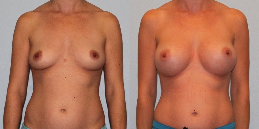 Breast Augmentation - Case 19309