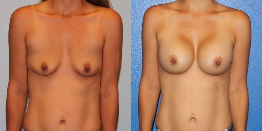 Breast Augmentation - Case 19312