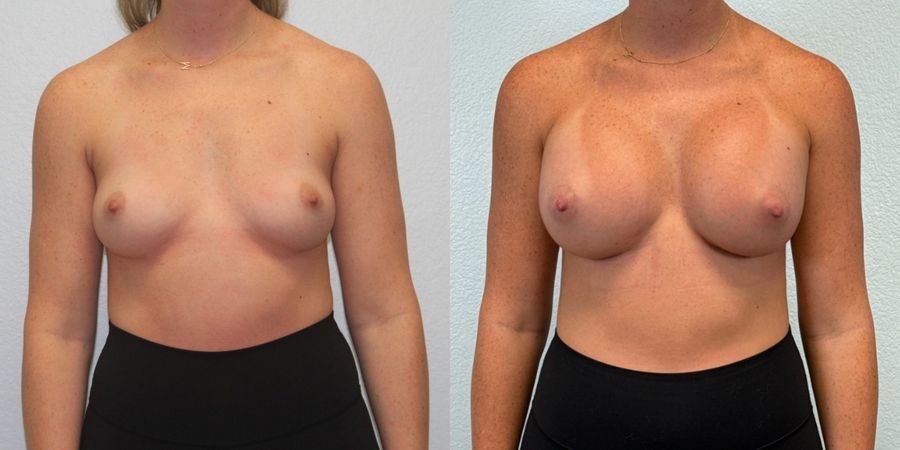 Breast Augmentation - Case 19346