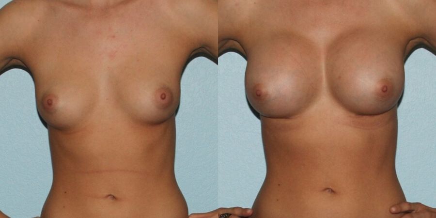 Breast Augmentation - Case 19340