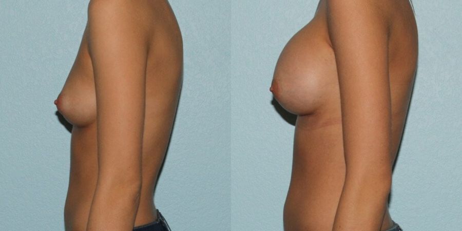Breast Augmentation - Thumbnail 3