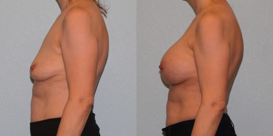 Breast Augmentation - Thumbnail 3