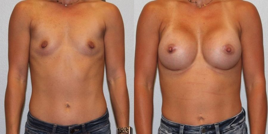 Breast Augmentation - Case 19345