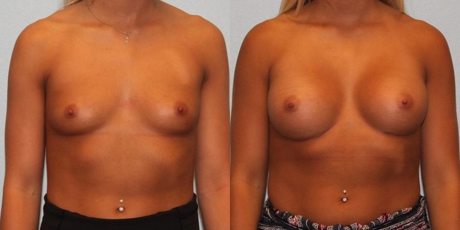 Breast Augmentation - Case 19311