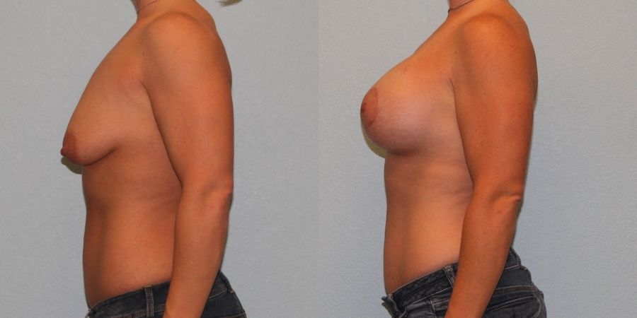 Breast Augmentation with Lift - Thumbnail 3