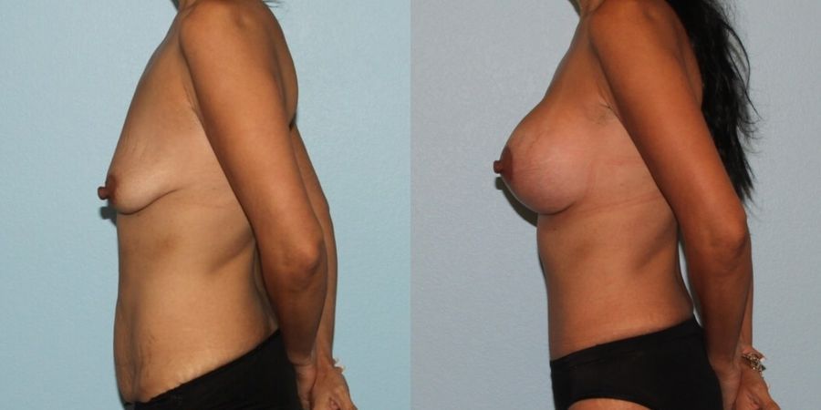 Breast Augmentation with Lift - Thumbnail 3