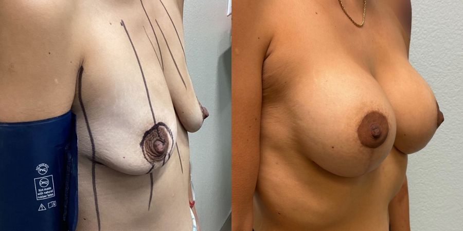 Breast Augmentation with Lift - Thumbnail 3