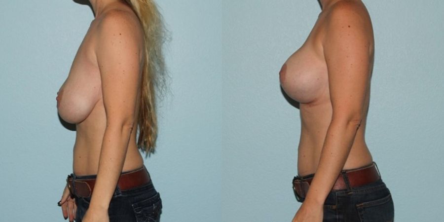 Breast Augmentation with Lift - Thumbnail 3