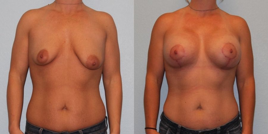 Breast Augmentation with Lift - Case 19361