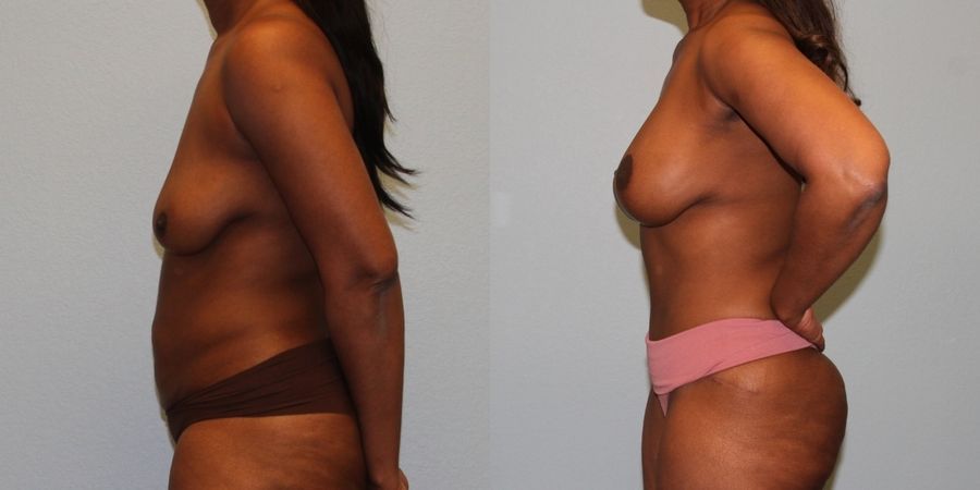 Breast Augmentation with Lift - Thumbnail 3
