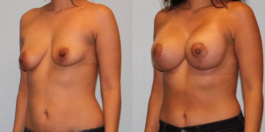 Breast Augmentation with Lift - Thumbnail 2