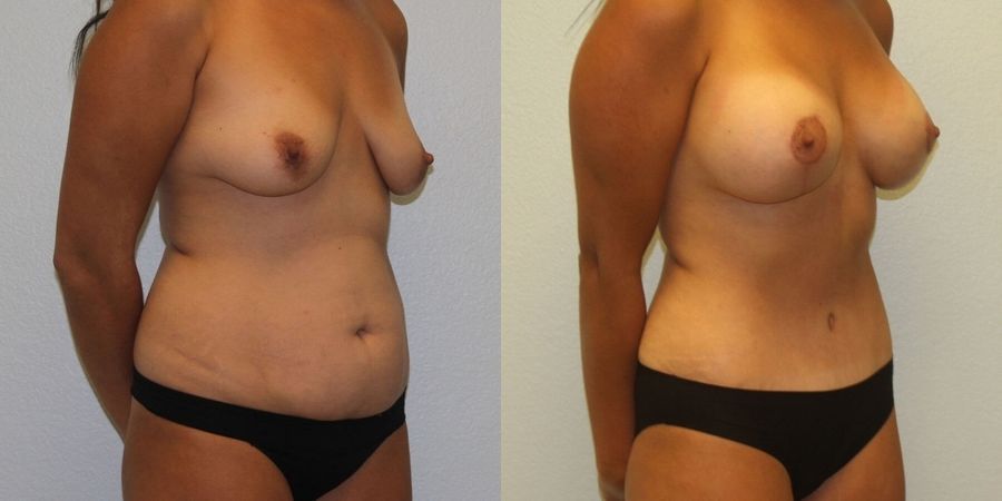 Breast Augmentation with Lift - Thumbnail 2
